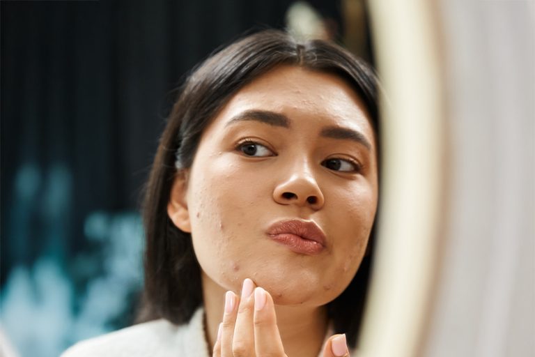 Home 5 Dull-Skin-Acne-and-Stubborn-Imperfections-vancouver-kimberly-de-matos-skin-care-studio